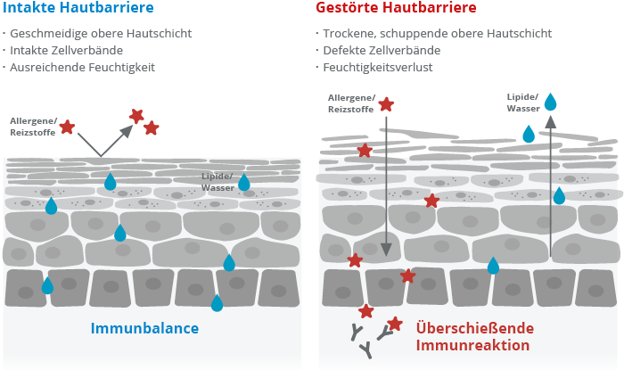 Bei Neurodermitis ist die Hautbarriere gest&ouml;rt.