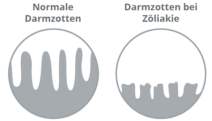 Ver&auml;nderungen der Darmschleimhaut bei Z&ouml;liakie